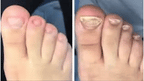 Patchs Correcteurs d'Ongles Incarnés