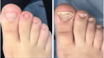Patchs Correcteurs d'Ongles Incarnés