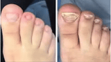 Patchs Correcteurs d'Ongles Incarnés